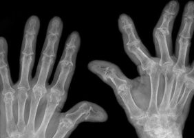Image of Rheumatoid Arthritis in hands
