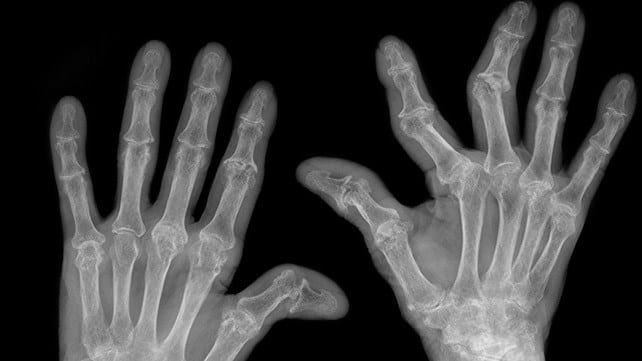 Image of Rheumatoid Arthritis in hands